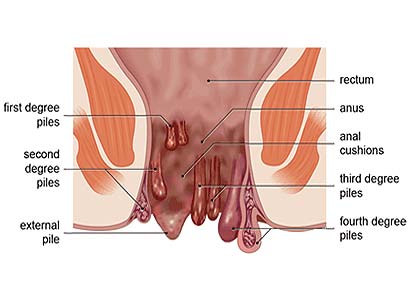 Hemorrhoids Piles treatment in pune - piles clinic